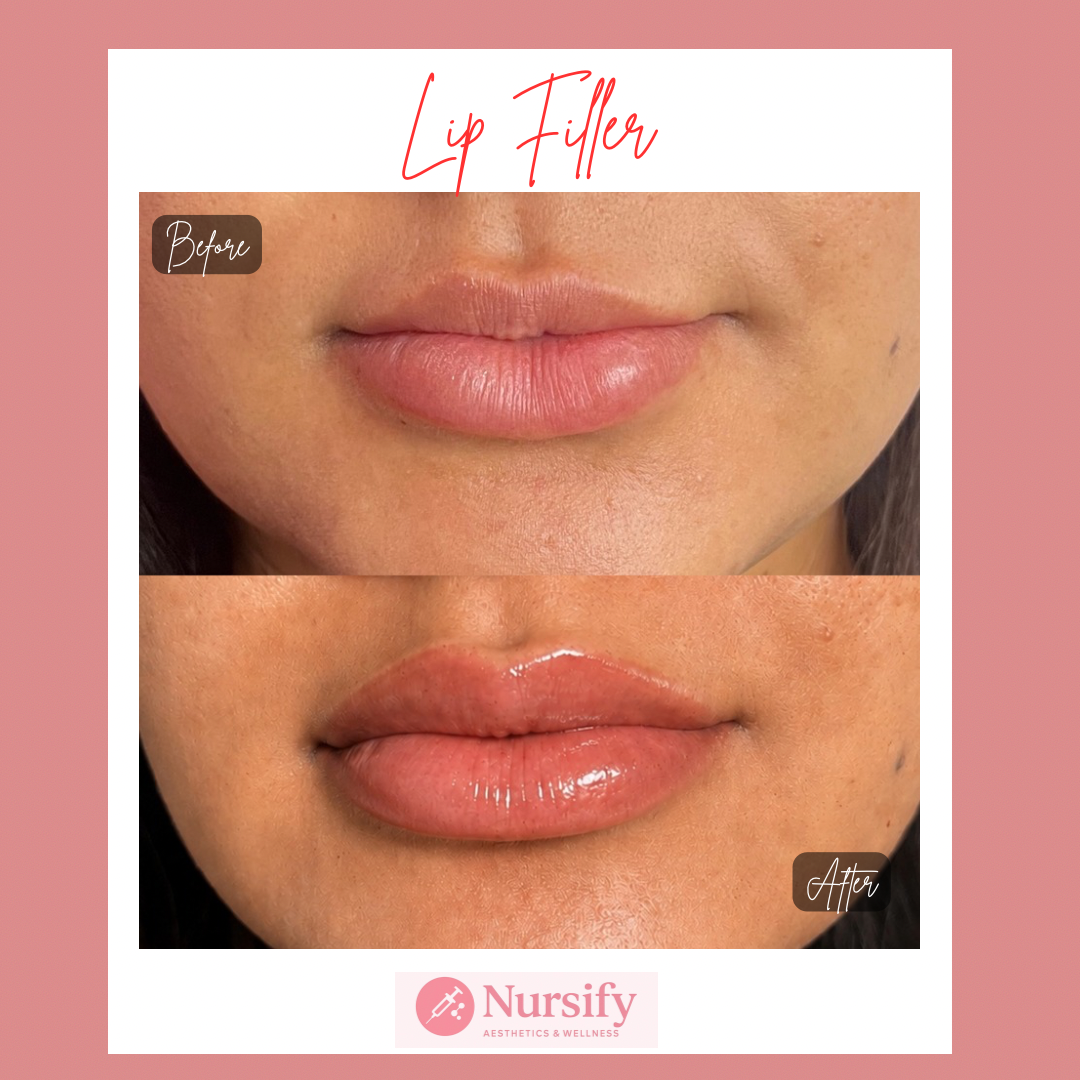 Dermal filler results Albuquerque NM